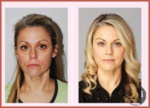 facial-flex-comparatif