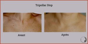 tripollar-stop-efficacite