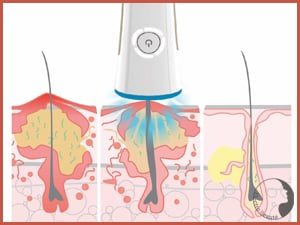 rio-q-acne-explication