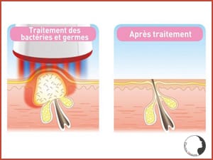 skin-clear-rio-explication