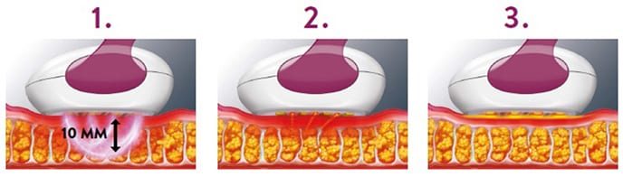 technologie-bipolaire-lumineuse-thermique